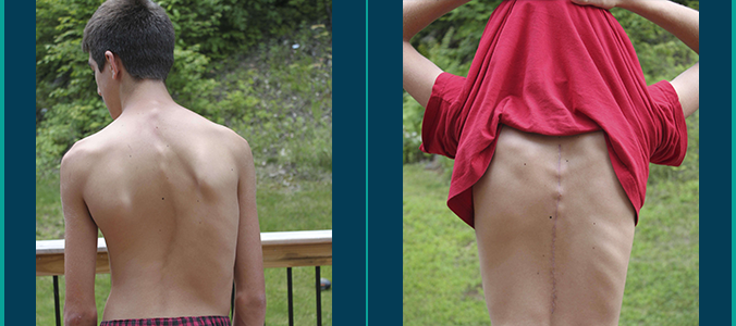 jared before and after scoliosis surgery