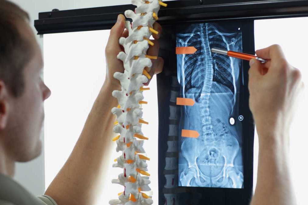spinal misalignment diagnosis for scoliosis