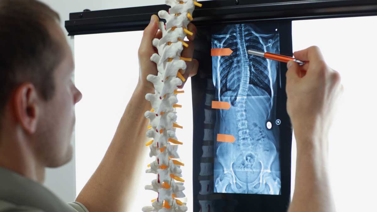 spinal misalignment diagnosis for scoliosis