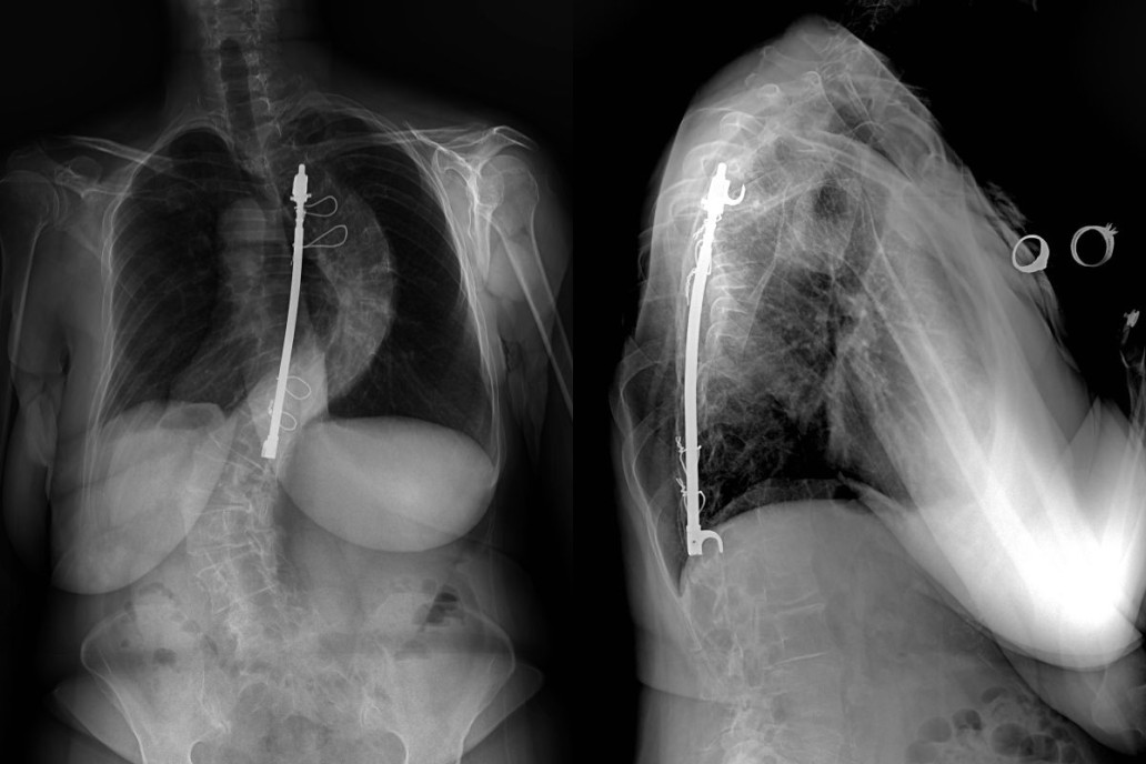 The Evolution of Scoliosis Treatment A Look at Harrington Rods